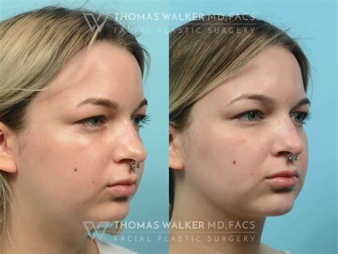 buccal fat removal 10 years later|Buccal Fat Removal 10 Years Later: Does The。